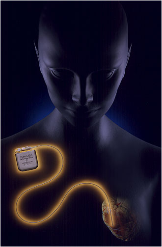 [ Pacemaker Photo ]